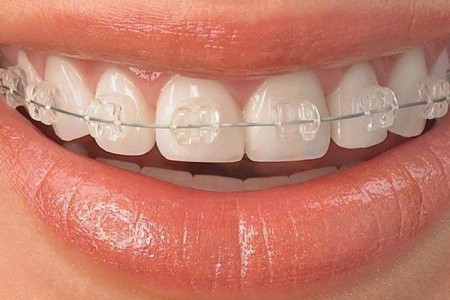 Fiksne proteze - cena