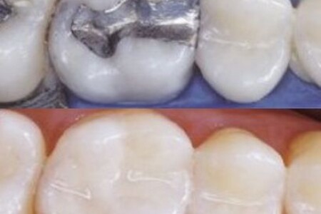 Da li su bolje bele ili amalgamske plombe?
