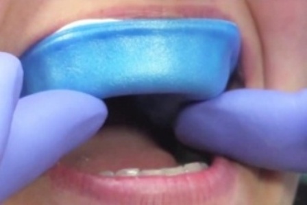 Da li je izbeljivanje zuba štetno 