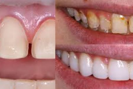 Keramičke fasete (viniri)