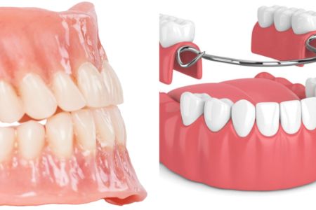 Kombinovani protetski radovi