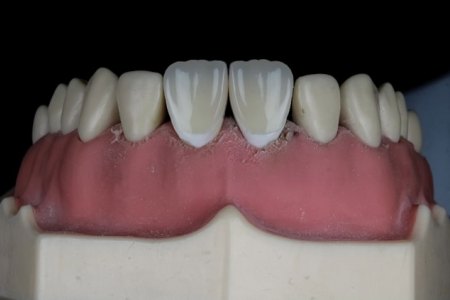 Parcijalne akrilatne proteze