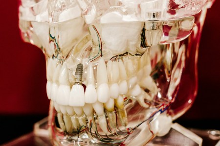 Resorbovanje i povlačenje kosti