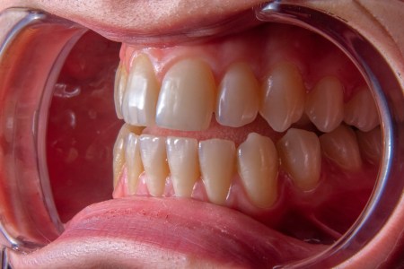 Uklanjanje zubnog kamenca