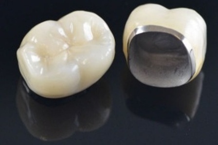 Metalokeramičkе krunicе i mostovi