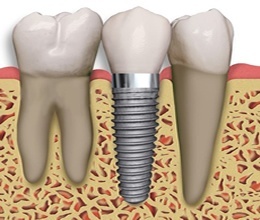 Zubni implanti