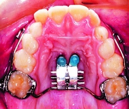 Ortopedija vilica - Stomatološka ordinacija Extradental Beograd