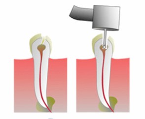 Sanacija bola i zapaljenja zuba