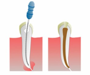 Lečenje pulpitisa i gangrene – spašavanje zuba endodontskom terapijom