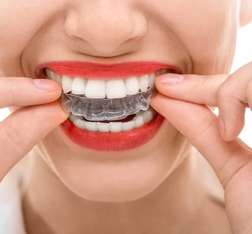 Folije za ispravljanje zuba