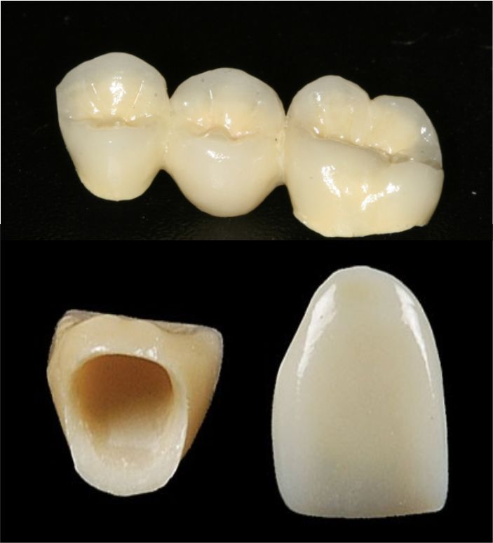Bezmetalne krunice i mostovi
