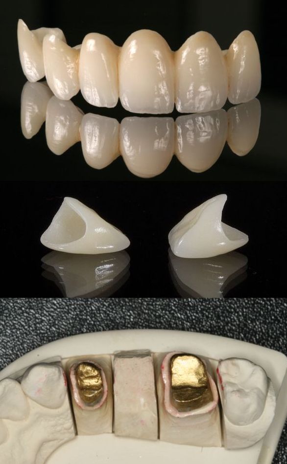 Bezmetalne krunice i mostovi