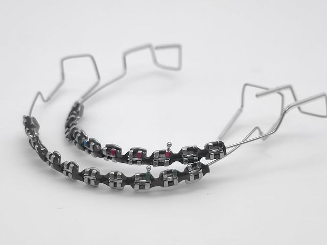 Metalne fiksne proteze – najpouzdanija i najpovoljnija opcija