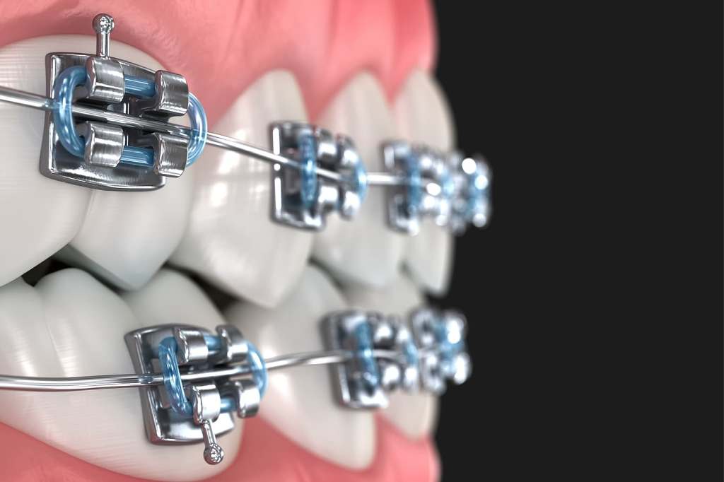 Metalne fiksne proteze – najpouzdanija i najpovoljnija opcija