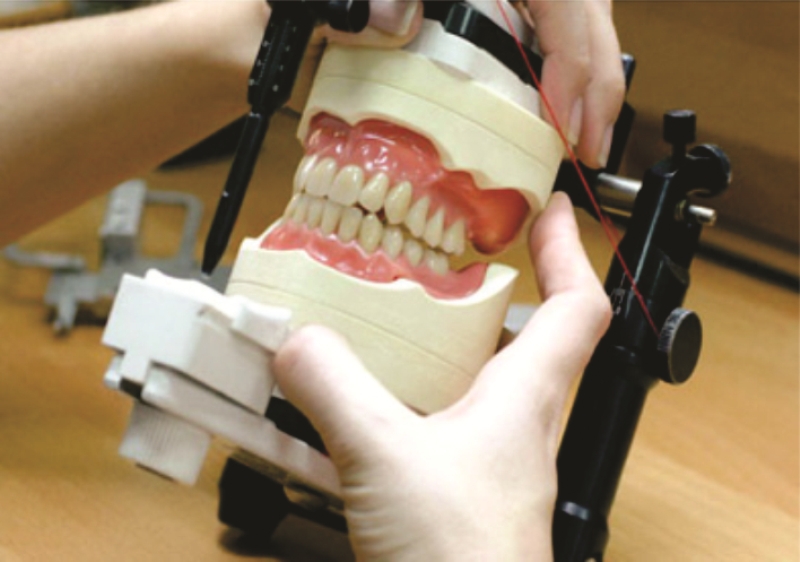 Bezmetalne krunice i mostovi