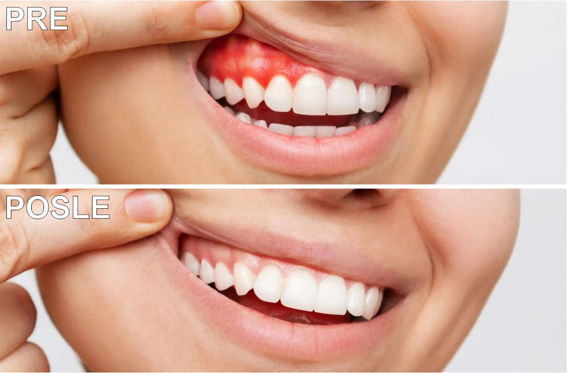 Lečenje parodontoze pre i posle