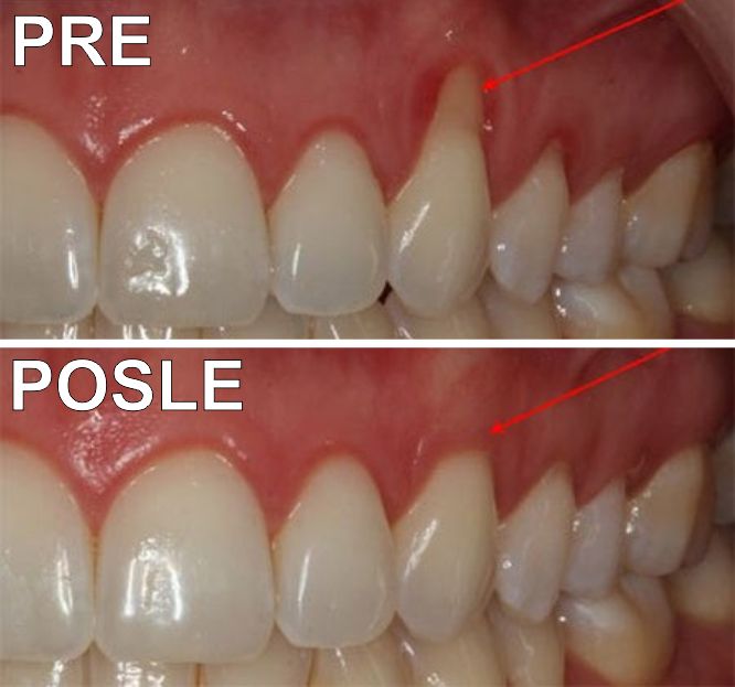 Lečenje parodontoze pre i posle