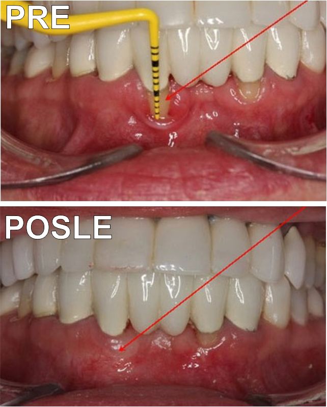 Lečenje parodontoze pre i posle