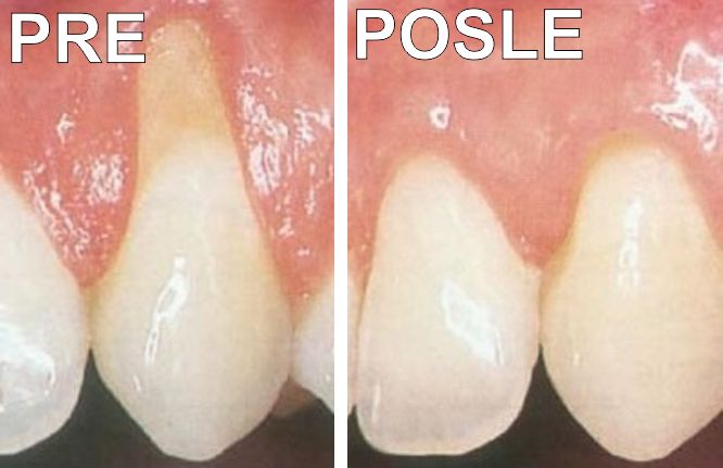 Lečenje parodontoze pre i posle