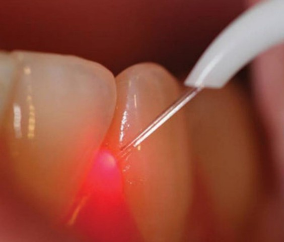 Lečenje zapaljenja desni (gingivitisa)